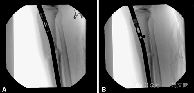 图解胫骨髓内钉技术（2025）
