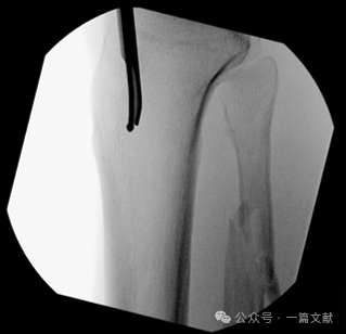 图解胫骨髓内钉技术（2025）