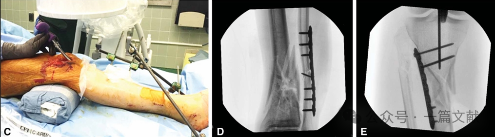 图解胫骨髓内钉技术（2025）