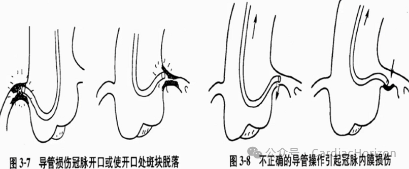 PCI术后常见并发症，你需要知道这些