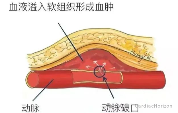 PCI术后常见并发症，你需要知道这些