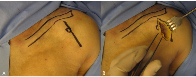 喙突骨折的ORIF：手术入路选择与固定技巧详解