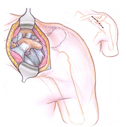 喙突骨折的ORIF：手术入路选择与固定技巧详解