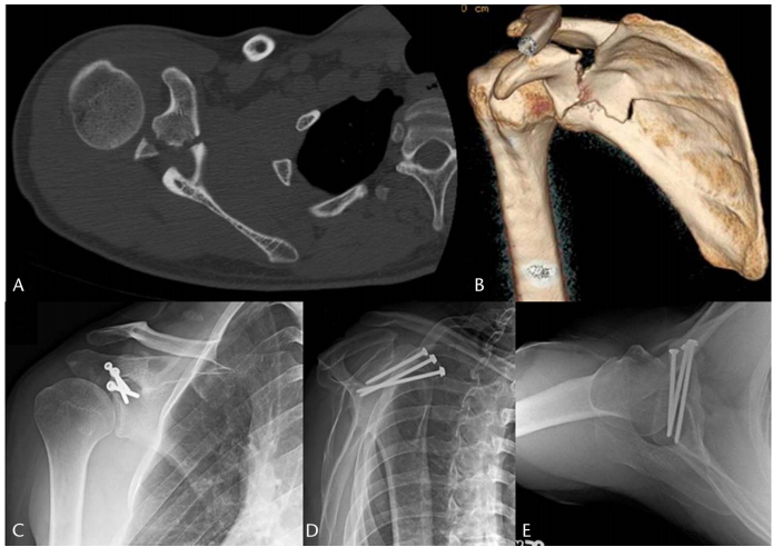 喙突骨折的ORIF：手术入路选择与固定技巧详解