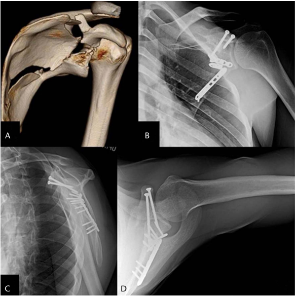 喙突骨折的ORIF：手术入路选择与固定技巧详解