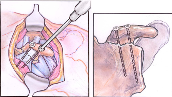 喙突骨折的ORIF：手术入路选择与固定技巧详解