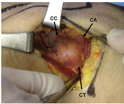 喙突骨折的ORIF：手术入路选择与固定技巧详解