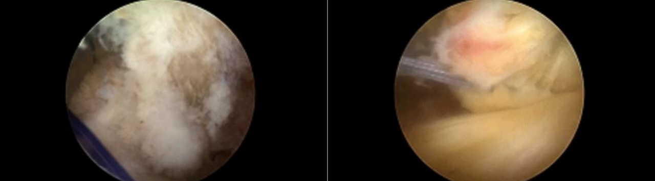 镜下双袢联合高强线“三重”固定后交叉胫骨止点撕脱骨折及分型