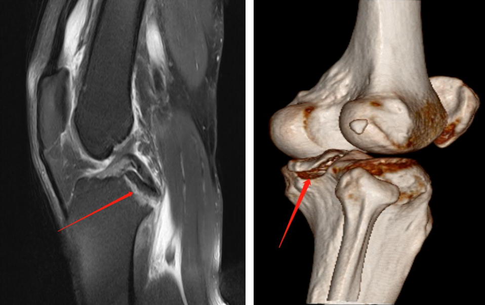 镜下双袢联合高强线“三重”固定后交叉胫骨止点撕脱骨折及分型