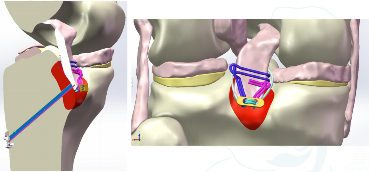 镜下双袢联合高强线“三重”固定后交叉胫骨止点撕脱骨折及分型