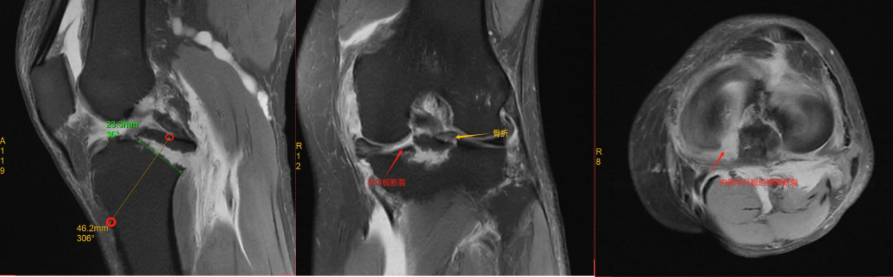 镜下双袢联合高强线“三重”固定后交叉胫骨止点撕脱骨折及分型