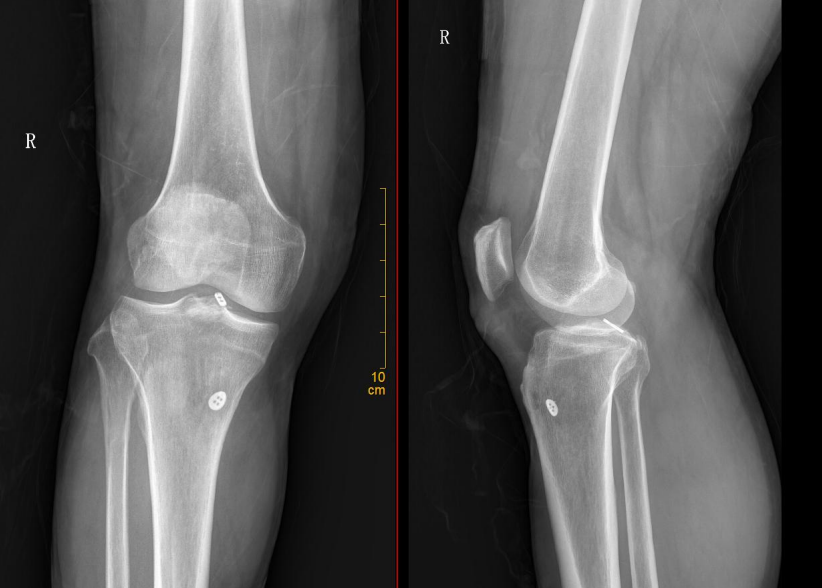 镜下双袢联合高强线“三重”固定后交叉胫骨止点撕脱骨折及分型