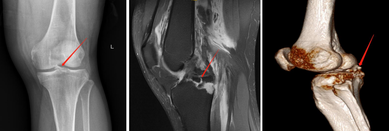 镜下双袢联合高强线“三重”固定后交叉胫骨止点撕脱骨折及分型