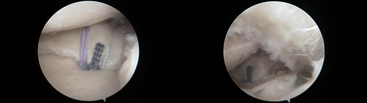 镜下双袢联合高强线“三重”固定后交叉胫骨止点撕脱骨折及分型