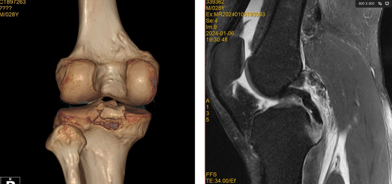 镜下双袢联合高强线“三重”固定后交叉胫骨止点撕脱骨折及分型