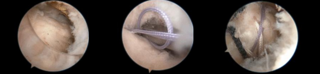 镜下双袢联合高强线“三重”固定后交叉胫骨止点撕脱骨折及分型