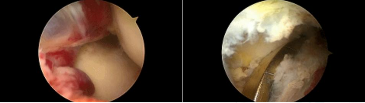 镜下双袢联合高强线“三重”固定后交叉胫骨止点撕脱骨折及分型