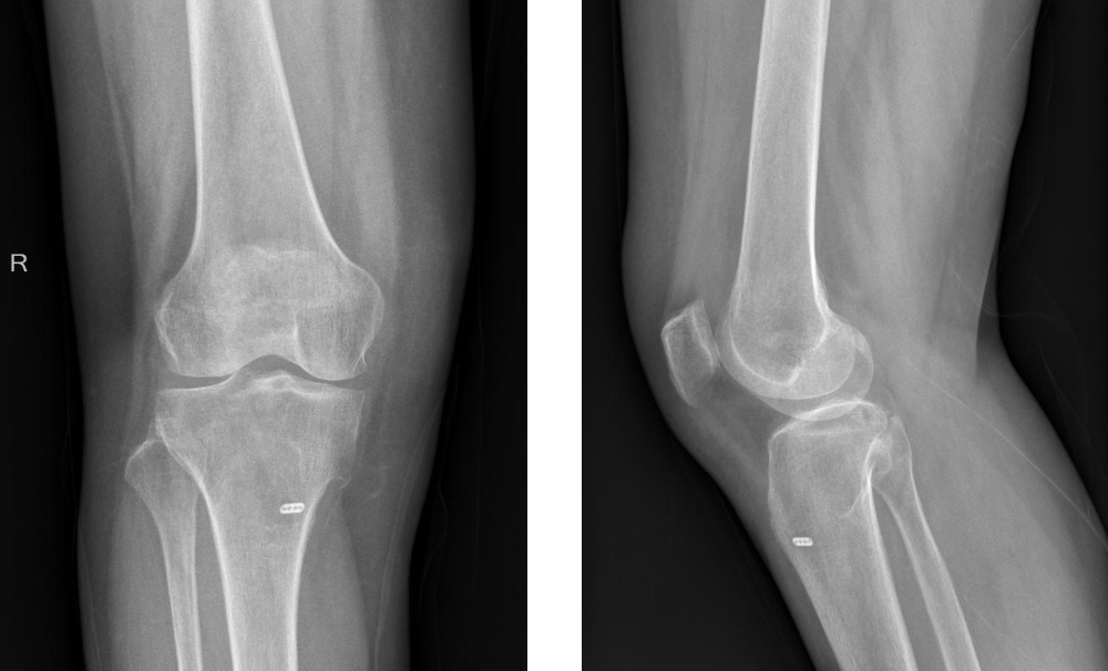 镜下双袢联合高强线“三重”固定后交叉胫骨止点撕脱骨折及分型