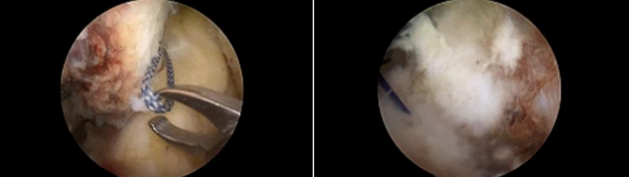 镜下双袢联合高强线“三重”固定后交叉胫骨止点撕脱骨折及分型