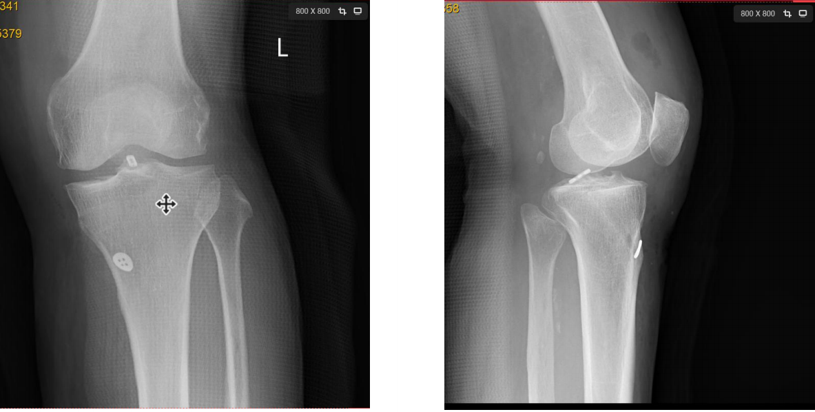 镜下双袢联合高强线“三重”固定后交叉胫骨止点撕脱骨折及分型