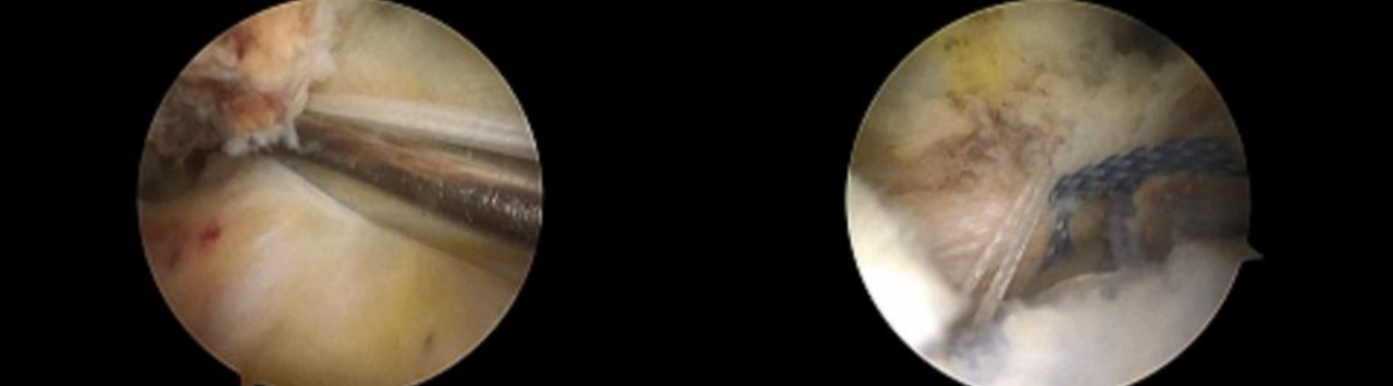 镜下双袢联合高强线“三重”固定后交叉胫骨止点撕脱骨折及分型