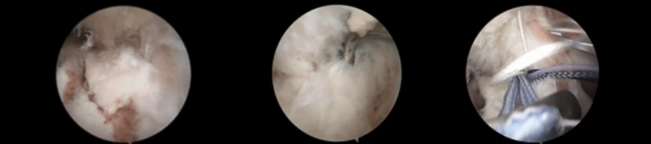 镜下双袢联合高强线“三重”固定后交叉胫骨止点撕脱骨折及分型