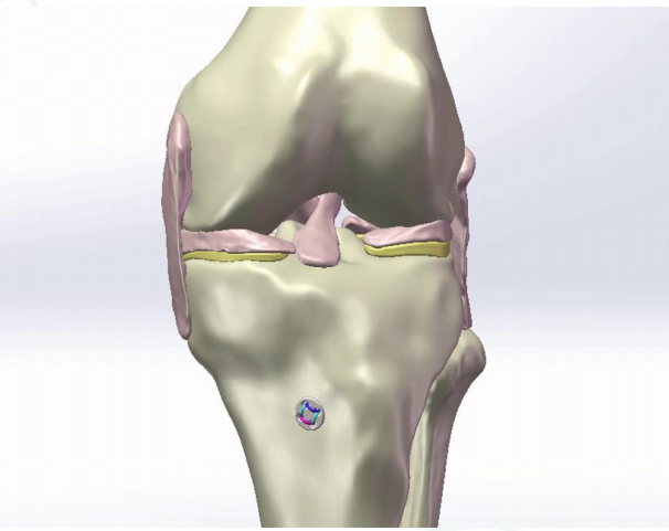 镜下双袢联合高强线“三重”固定后交叉胫骨止点撕脱骨折及分型