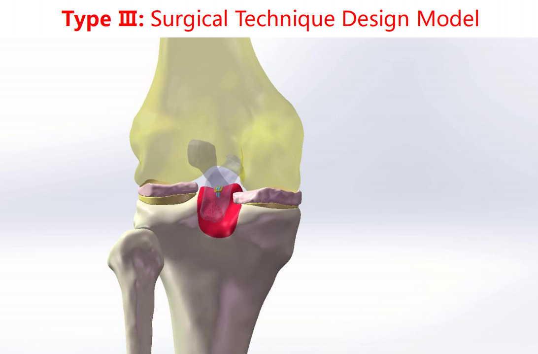 镜下双袢联合高强线“三重”固定后交叉胫骨止点撕脱骨折及分型