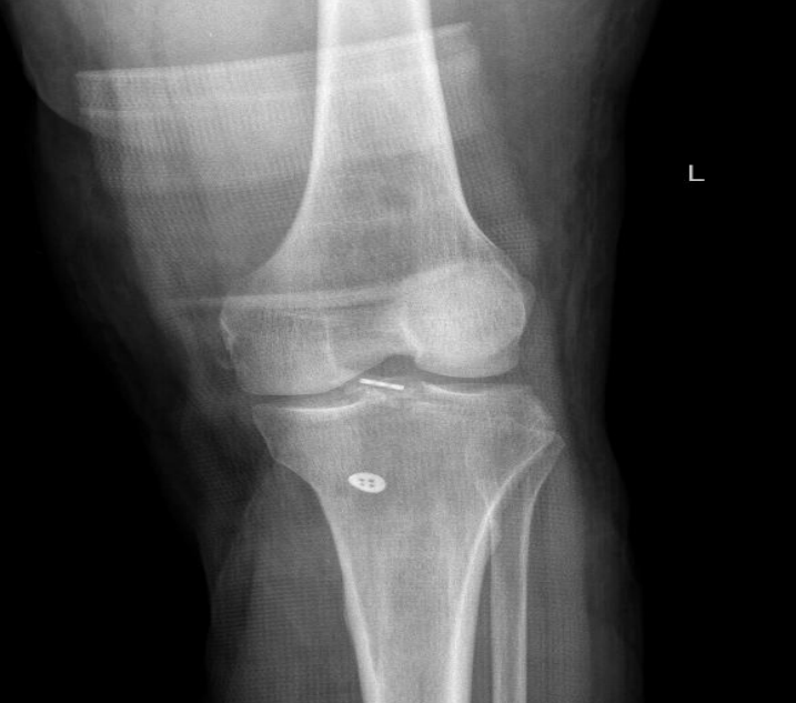 镜下双袢联合高强线“三重”固定后交叉胫骨止点撕脱骨折及分型