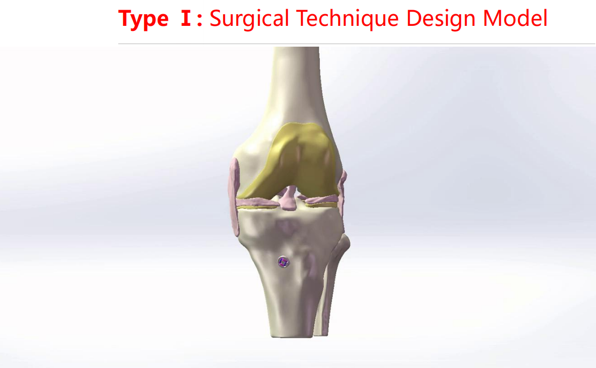 镜下双袢联合高强线“三重”固定后交叉胫骨止点撕脱骨折及分型
