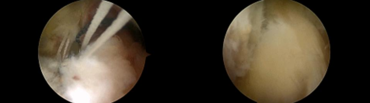 镜下双袢联合高强线“三重”固定后交叉胫骨止点撕脱骨折及分型