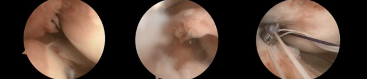 镜下双袢联合高强线“三重”固定后交叉胫骨止点撕脱骨折及分型