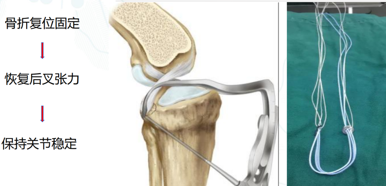 镜下双袢联合高强线“三重”固定后交叉胫骨止点撕脱骨折及分型