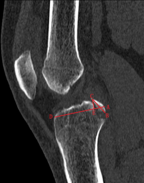 镜下双袢联合高强线“三重”固定后交叉胫骨止点撕脱骨折及分型