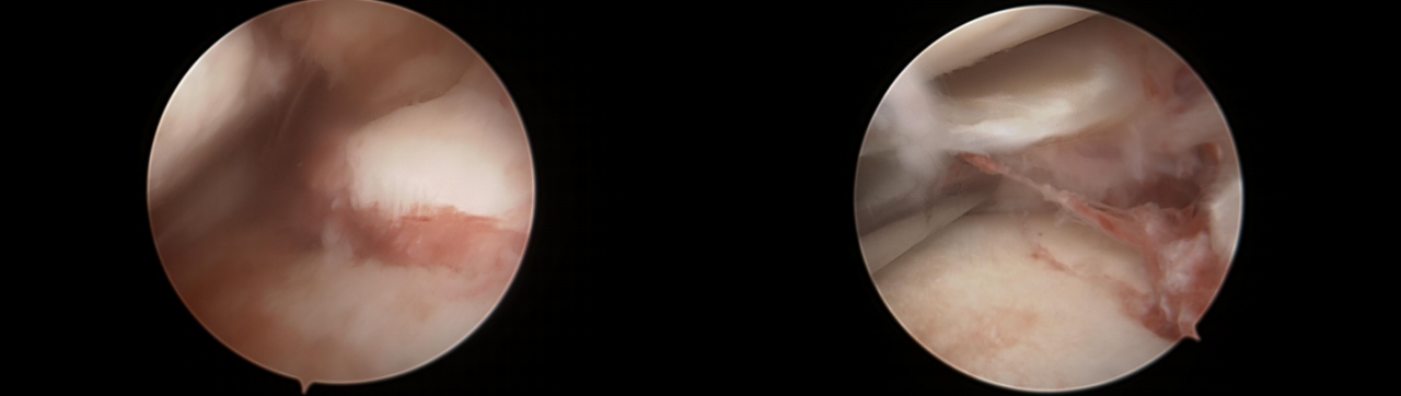 镜下双袢联合高强线“三重”固定后交叉胫骨止点撕脱骨折及分型