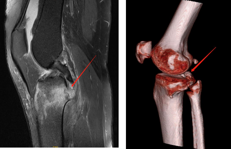 镜下双袢联合高强线“三重”固定后交叉胫骨止点撕脱骨折及分型