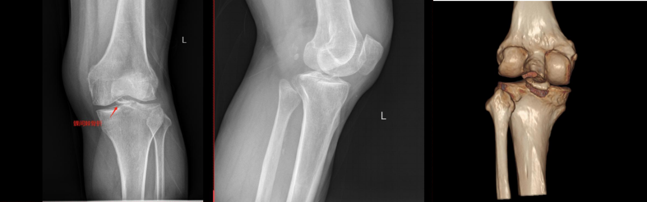 镜下双袢联合高强线“三重”固定后交叉胫骨止点撕脱骨折及分型