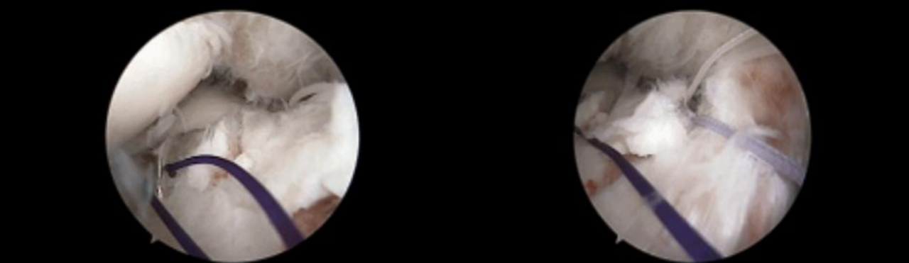 镜下双袢联合高强线“三重”固定后交叉胫骨止点撕脱骨折及分型