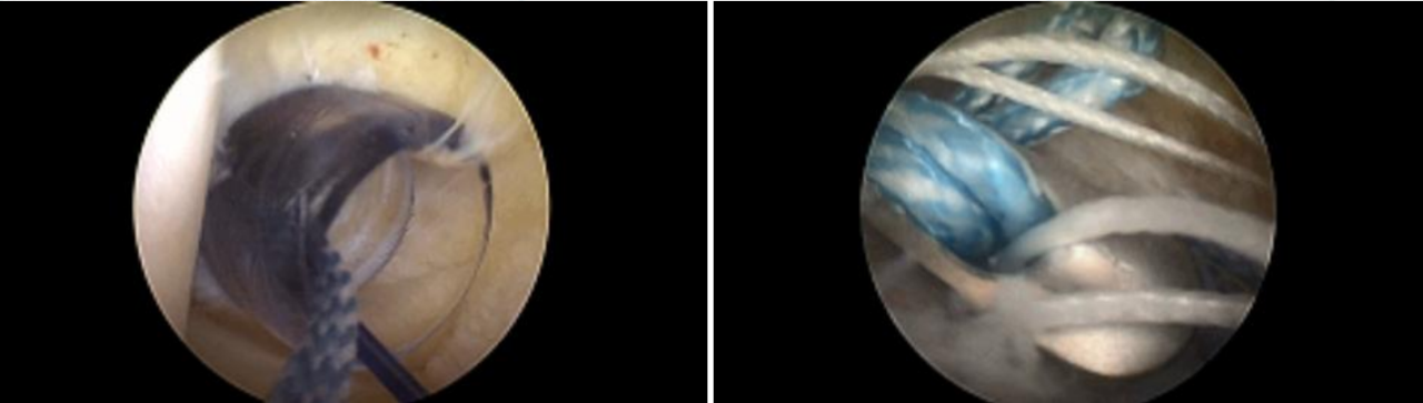 镜下双袢联合高强线“三重”固定后交叉胫骨止点撕脱骨折及分型