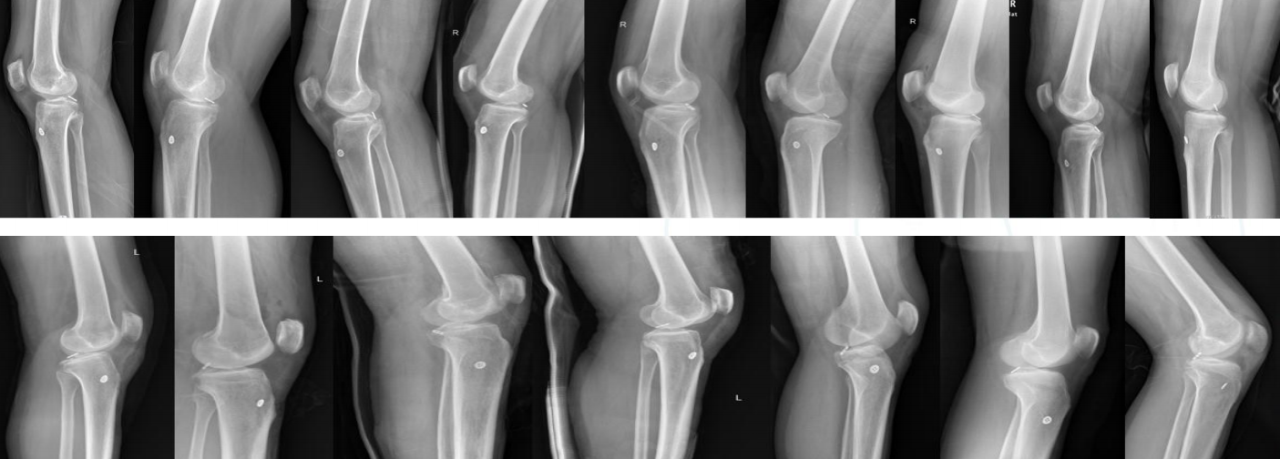 镜下双袢联合高强线“三重”固定后交叉胫骨止点撕脱骨折及分型