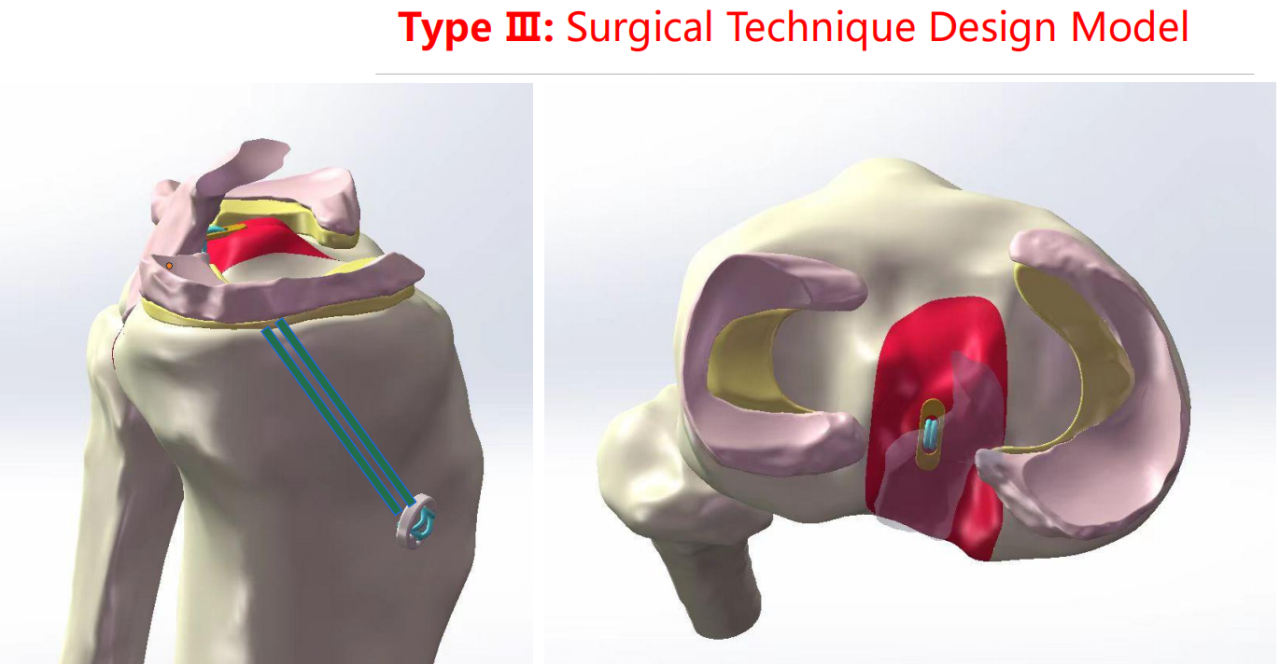 镜下双袢联合高强线“三重”固定后交叉胫骨止点撕脱骨折及分型