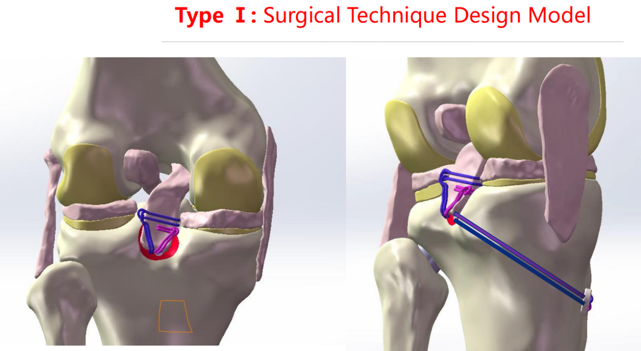 镜下双袢联合高强线“三重”固定后交叉胫骨止点撕脱骨折及分型