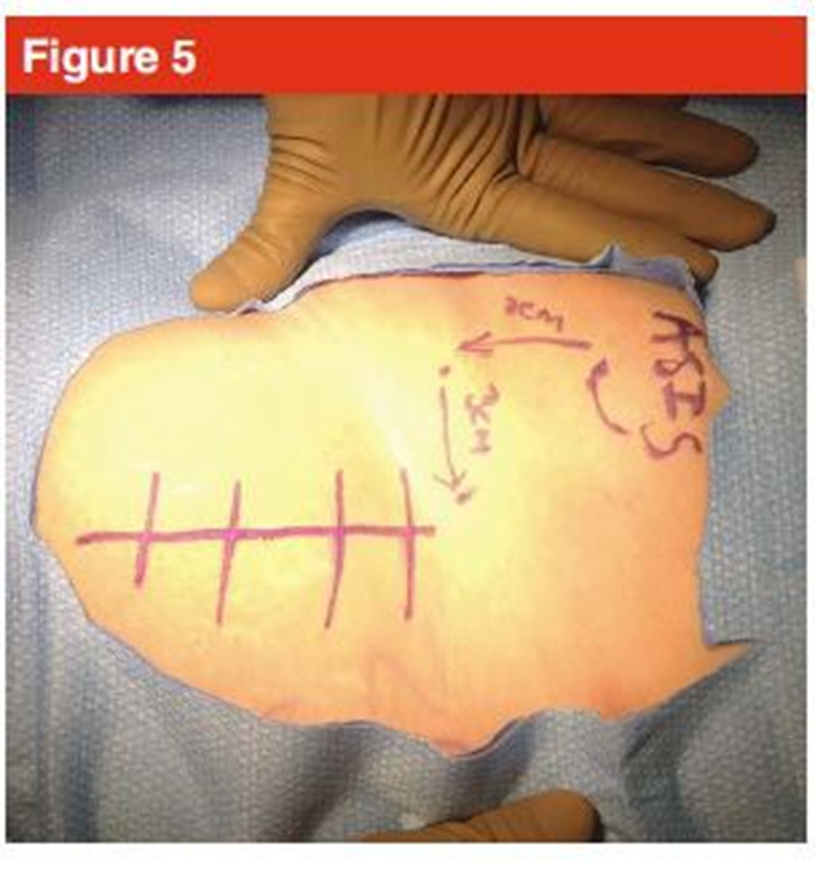 手术技巧:人工髋关节置换术,骨科医生须掌握!