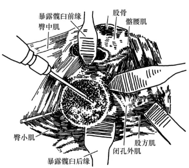 手术技巧:人工髋关节置换术,骨科医生须掌握!
