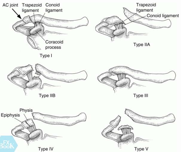 锁骨远端骨折内固定后为什么会翘起来？