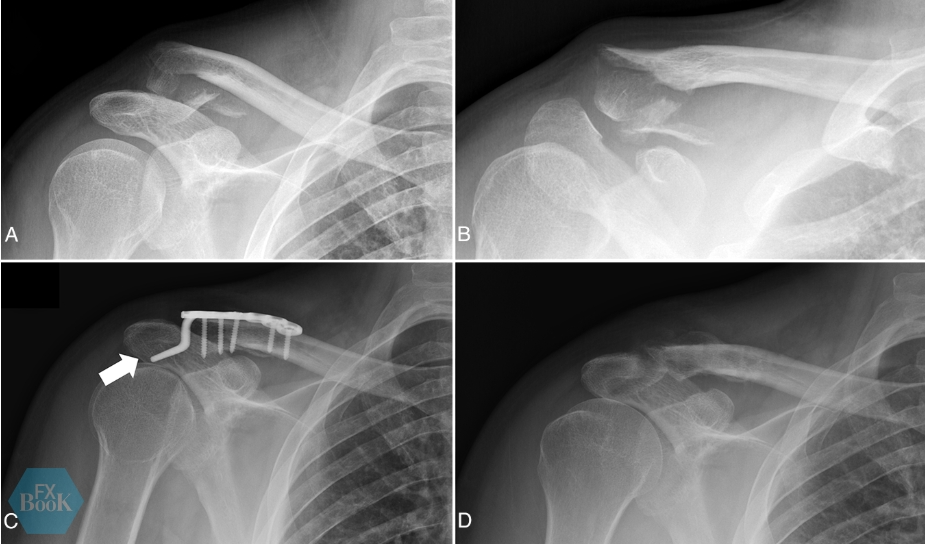 锁骨远端骨折内固定后为什么会翘起来？