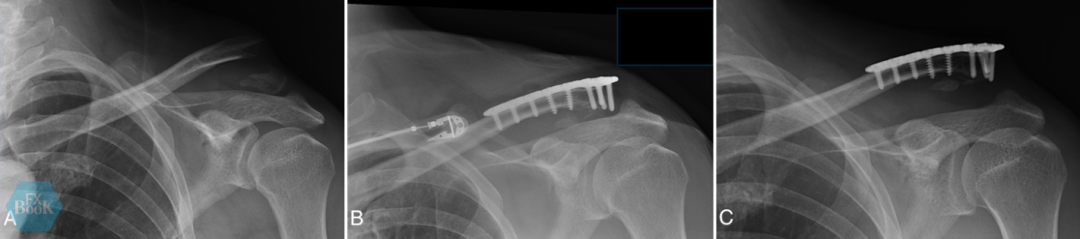 锁骨远端骨折内固定后为什么会翘起来？