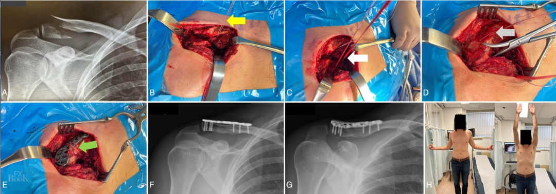 锁骨远端骨折内固定后为什么会翘起来？