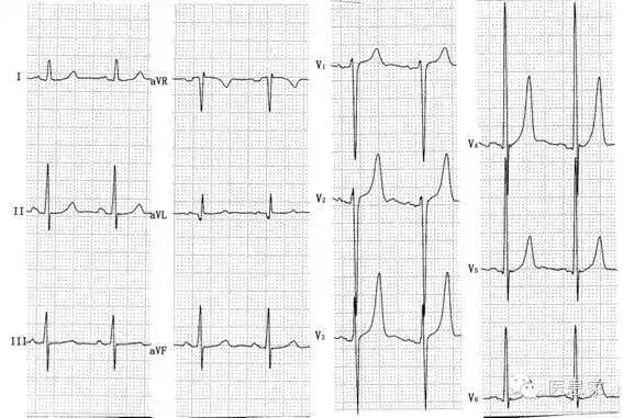 致命心电图,值班请牢记!