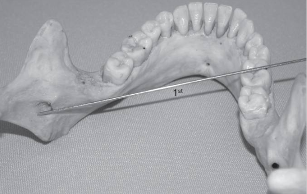 下牙槽神经麻醉的新方法！看起来挺厉害